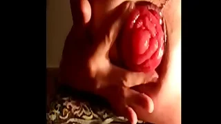 My anal prolapse in progress